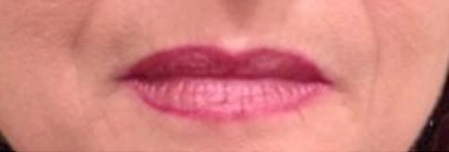 After Image: Lip Filler - front