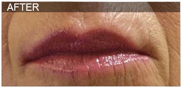 After Image: Lip Filler - front