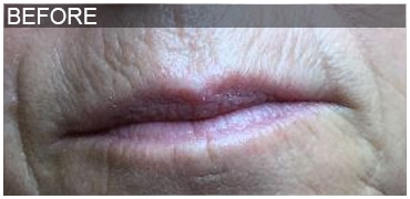 Before Image: Lip Filler - front