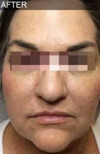 After Image: Liquid Facelift