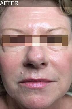 After Image: Liquid Facelift - front
