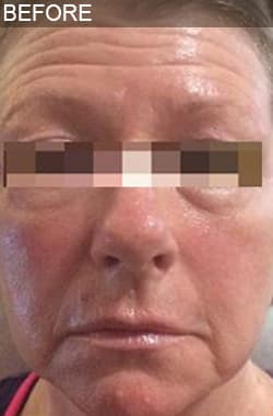 Before Image: Liquid Facelift - front
