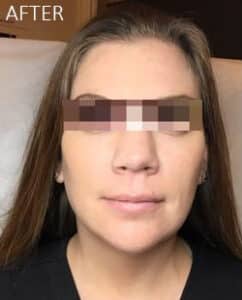 After Image: Liquid Facelift
