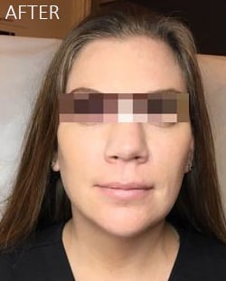 After Image: Liquid Facelift - front