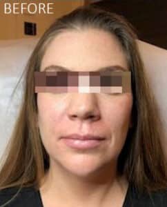 Before Image: Liquid Facelift