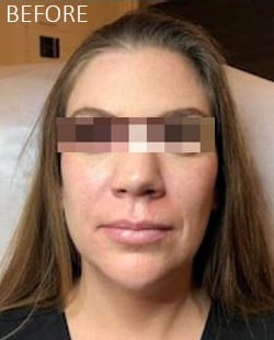 Before Image: Liquid Facelift - front