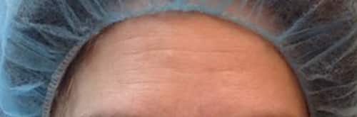 Before Image: MicroPen - front