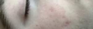 Before Image: MicroPen