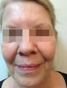 Before Image: Voluma