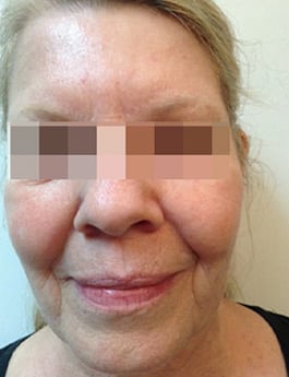 Before Image: Voluma - front