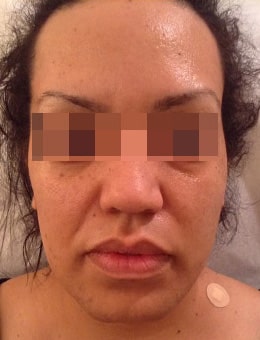 Before Image: Voluma - front