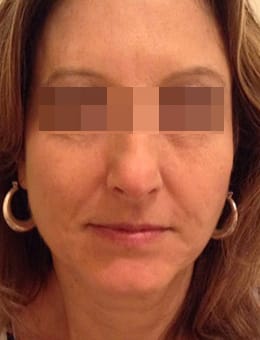 After Image: Voluma, Juvederm and Botox - front
