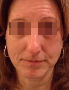 Before Image: Voluma, Juvederm and Botox