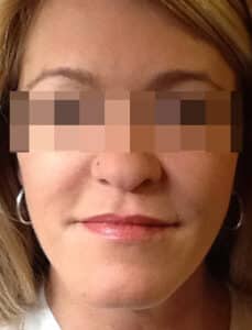 After Image: Juvederm