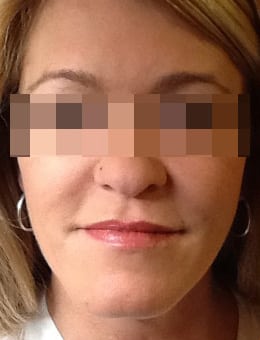 After Image: Juvederm - front