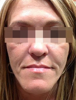 Before Image: Juvederm - front