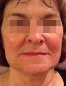 After Image: Juvederm and Voluma