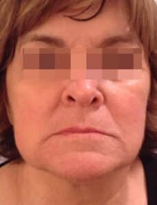 Before Image: Juvederm and Voluma