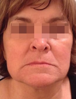 Before Image: Juvederm and Voluma - front