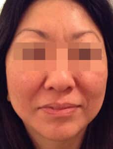 Juvederm and Voluma