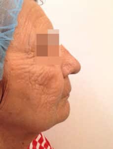 After Image: IPL/Photofacial