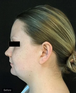 Before Image: Sculpsure - left-side