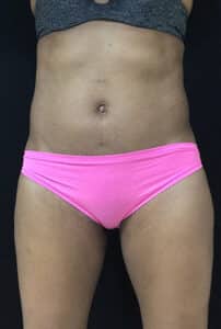 After Image: Sculpsure
