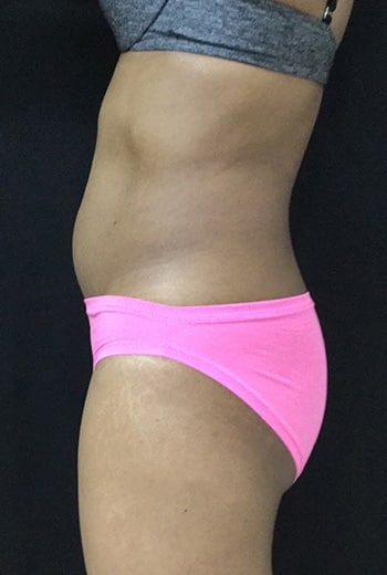 After Image: Sculpsure - left-side