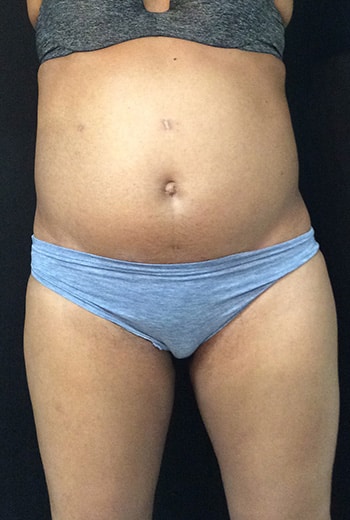 Before Image: Sculpsure - front