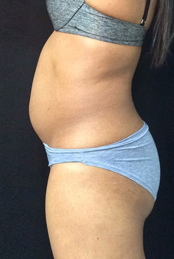 Before Image: Sculpsure - left-side