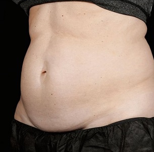 Before Image: Sculpsure - left-front-oblique