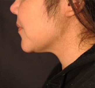 After Image: Sculpsure - left-side
