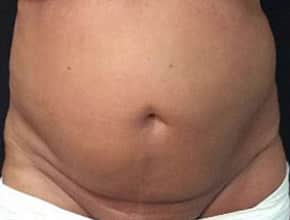After Image: Sculpsure - front