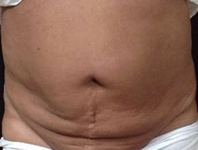 Before Image: Sculpsure - front
