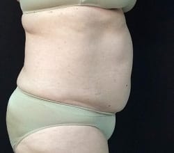 After Image: Sculpsure - right-side