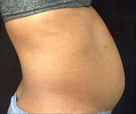Before Image: Sculpsure - right-side