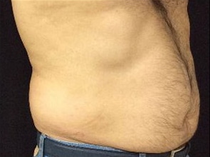 Before Image: Sculpsure - right-front-oblique
