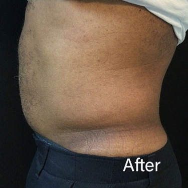 After Image: Sculpsure - left-side