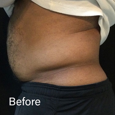 Before Image: Sculpsure - left-side