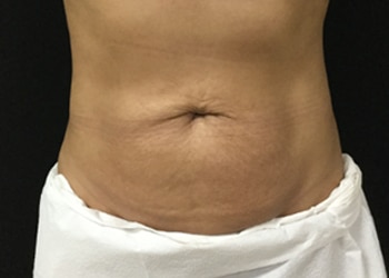After Image: Sculpsure - front