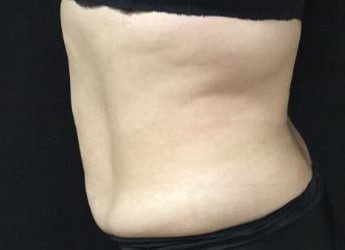 After Image: Sculpsure - left-side