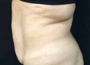 Sculpsure