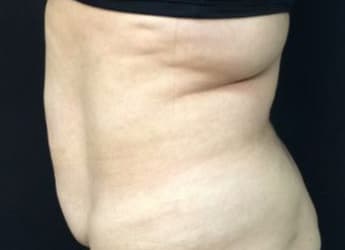Before Image: Sculpsure - left-side