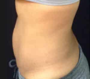 Sculpsure