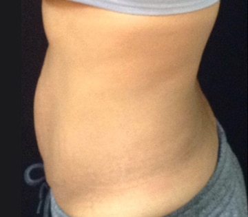After Image: Sculpsure - left-side