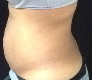 Before Image: Sculpsure - left-side