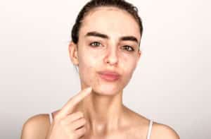 young girl with acne problematic skin