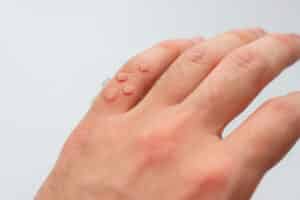 Viral warts on hand.