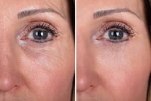 Woman With Before And After Rejuvenation
