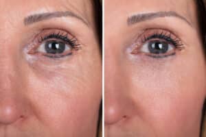 Woman With Before And After Rejuvenation